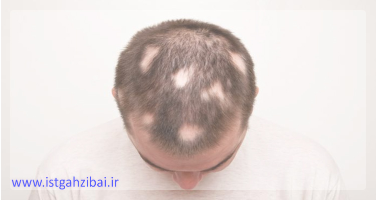 علت و درمان ریزش موی سکه ای